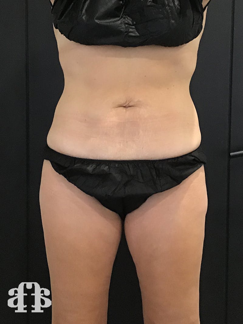 CoolSculpting Before & After Gallery - Patient 52660189 - Image 2