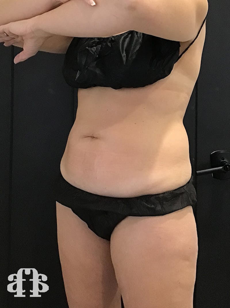 CoolSculpting Before & After Gallery - Patient 52660189 - Image 3