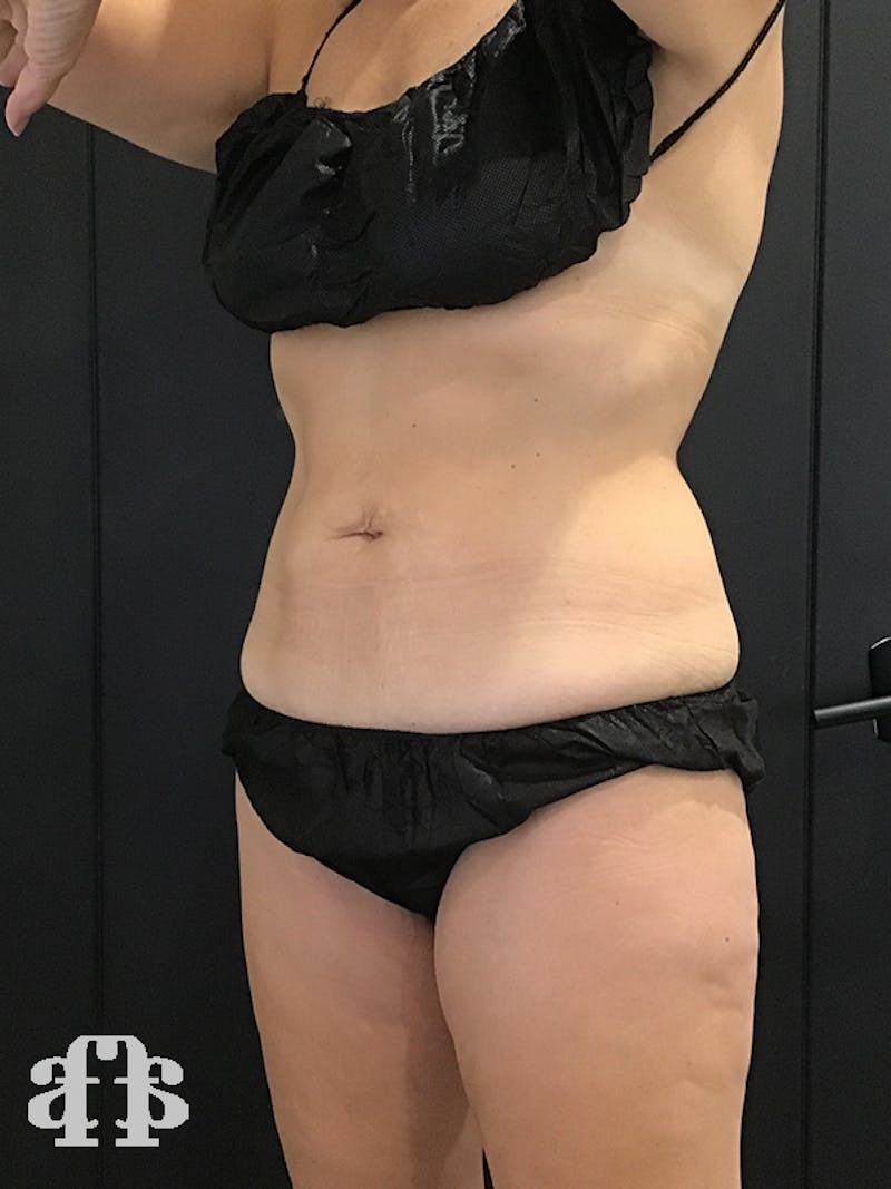 CoolSculpting Before & After Gallery - Patient 52660189 - Image 4