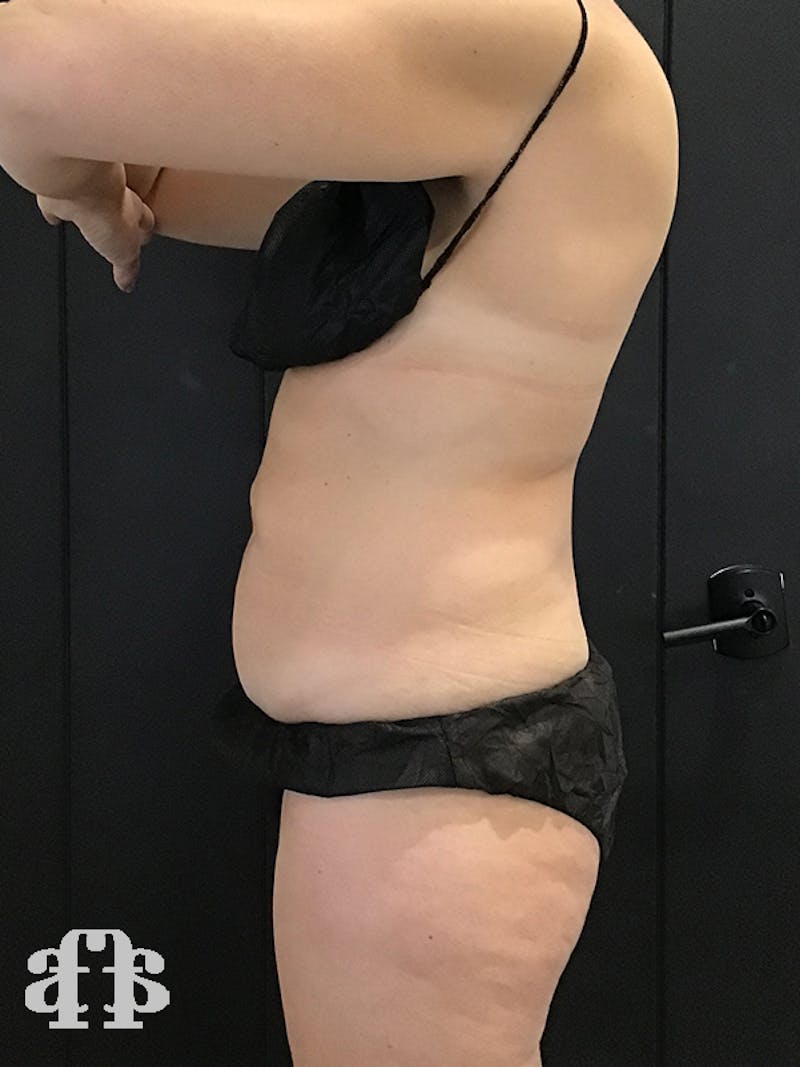 CoolSculpting Before & After Gallery - Patient 52660189 - Image 5