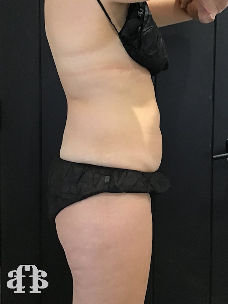 CoolSculpting Before & After Gallery - Patient 52660189 - Image 7
