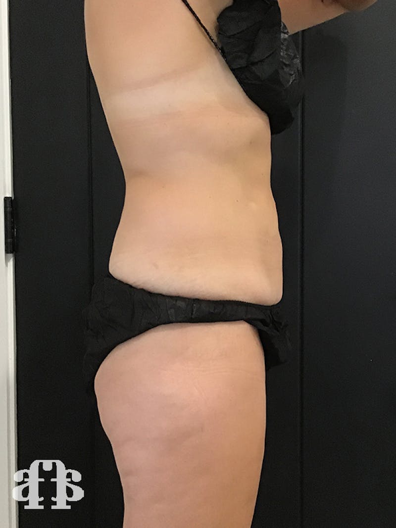 CoolSculpting Before & After Gallery - Patient 52660189 - Image 8
