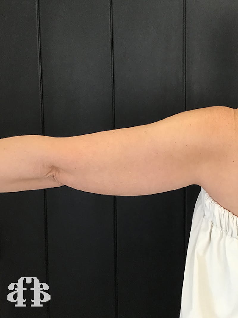 CoolSculpting Before & After Gallery - Patient 52660189 - Image 9