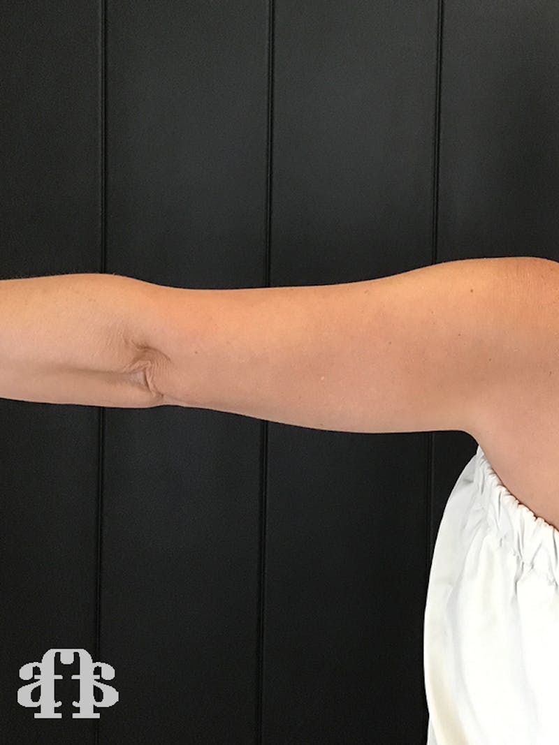 CoolSculpting Before & After Gallery - Patient 52660189 - Image 10