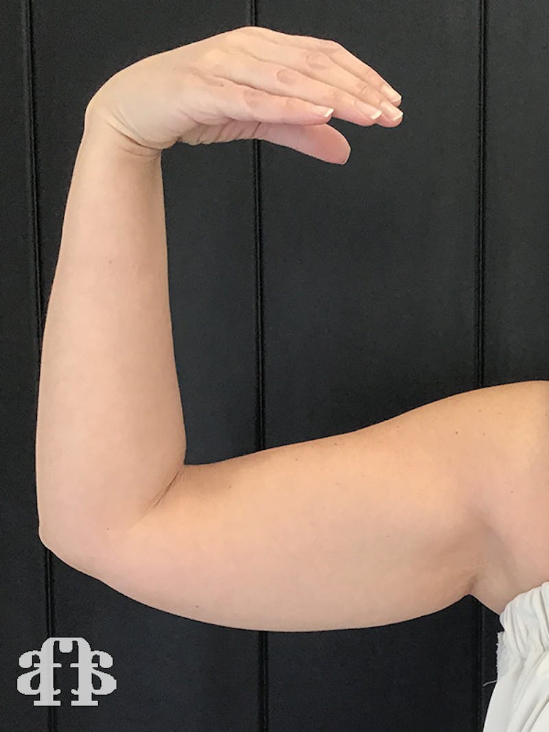 CoolSculpting Before & After Gallery - Patient 52660189 - Image 11