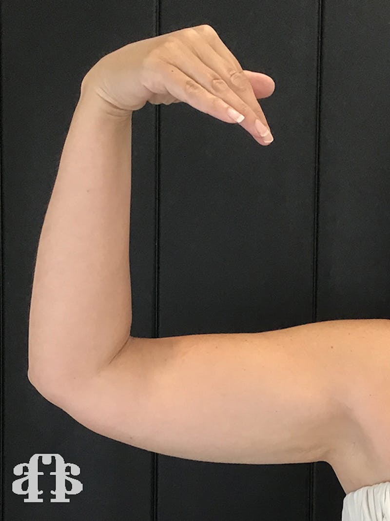 CoolSculpting Before & After Gallery - Patient 52660189 - Image 12