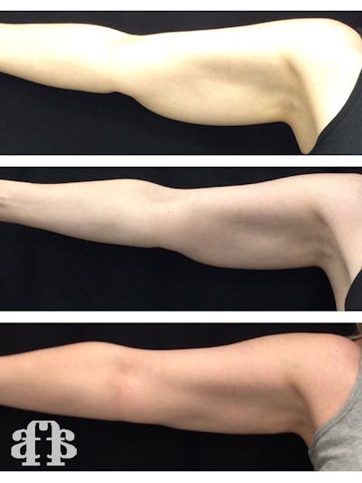 CoolSculpting Before & After Gallery - Patient 52660190 - Image 1