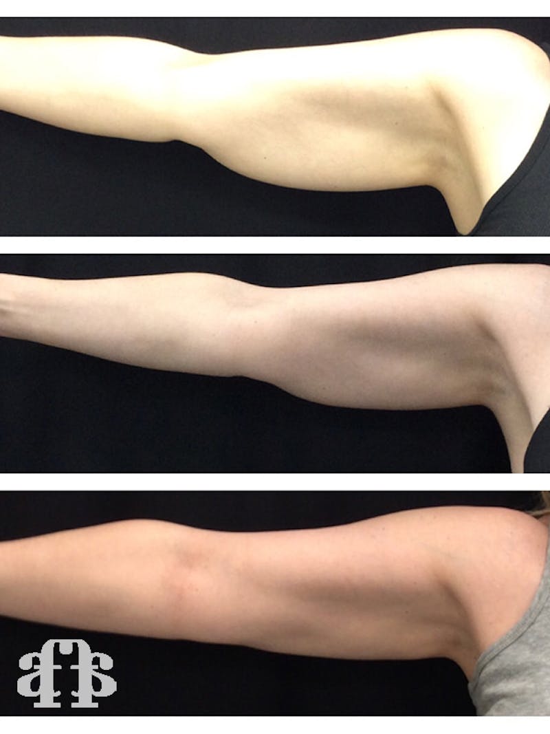 CoolSculpting Before & After Gallery - Patient 52660190 - Image 1