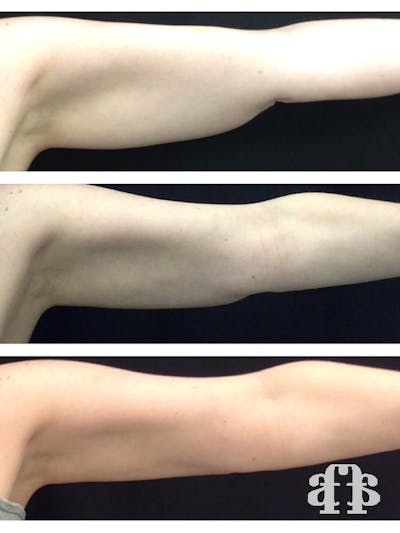 CoolSculpting Before & After Gallery - Patient 52660190 - Image 2