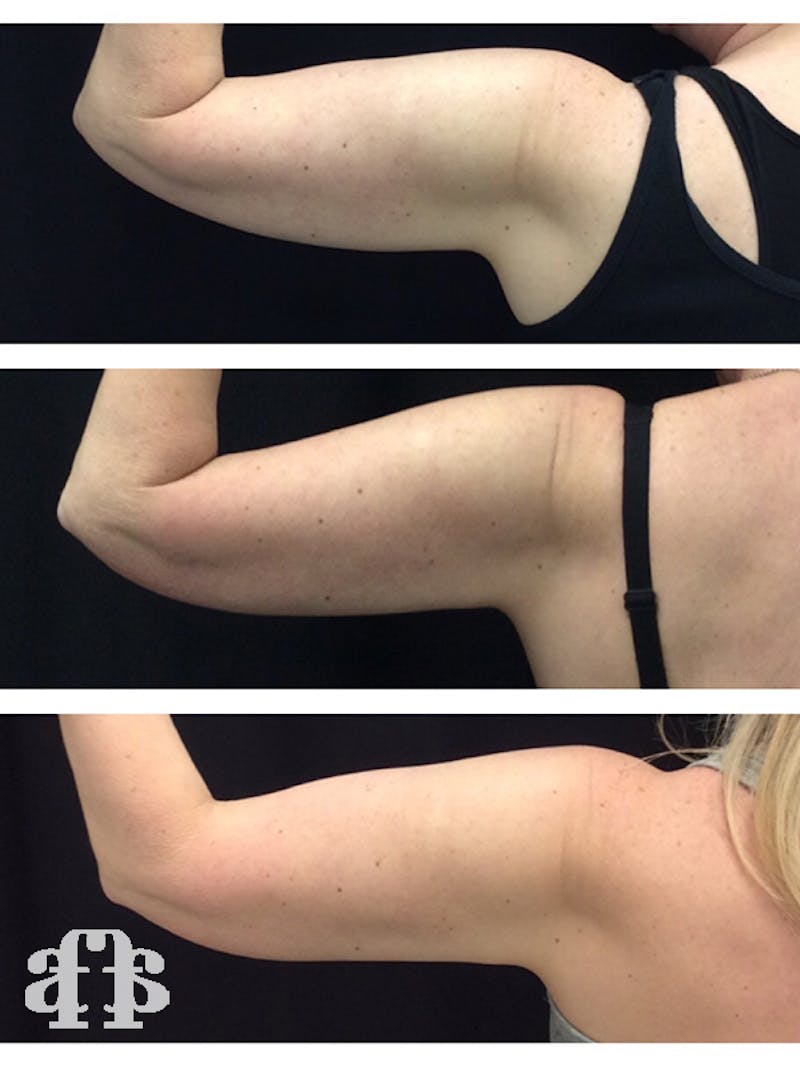 CoolSculpting Before & After Gallery - Patient 52660190 - Image 3
