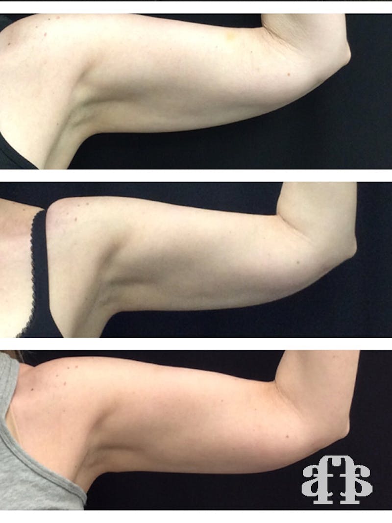 CoolSculpting Before & After Gallery - Patient 52660190 - Image 4