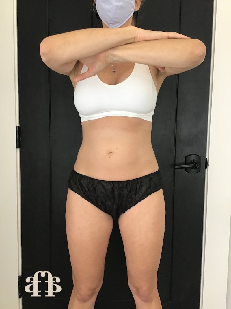CoolSculpting Before & After Gallery - Patient 148257165 - Image 2