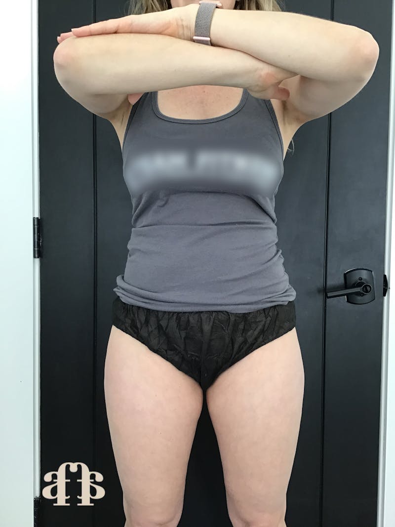 CoolSculpting Before & After Gallery - Patient 148257165 - Image 1
