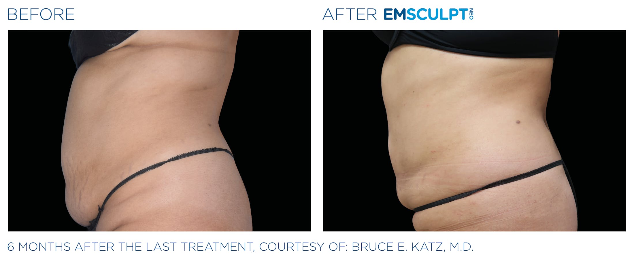 Emsculpt before & after