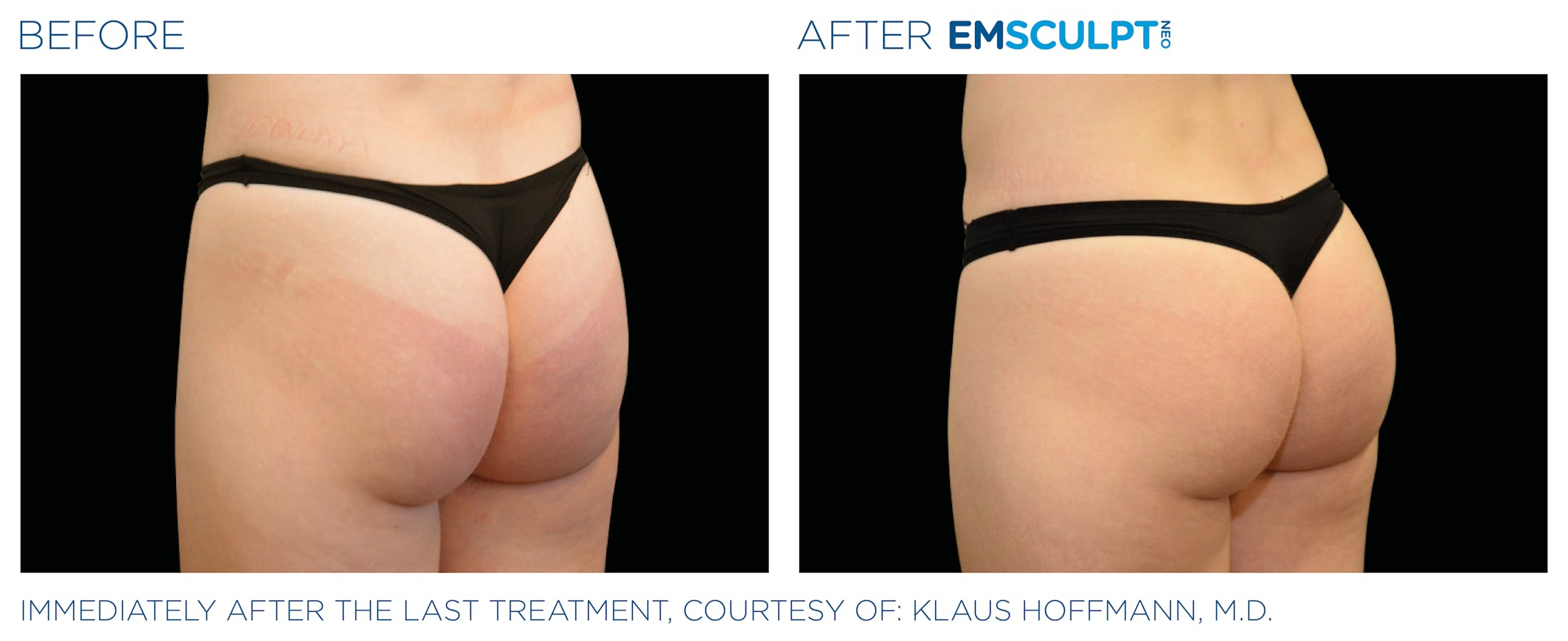 Emsculpt before & after