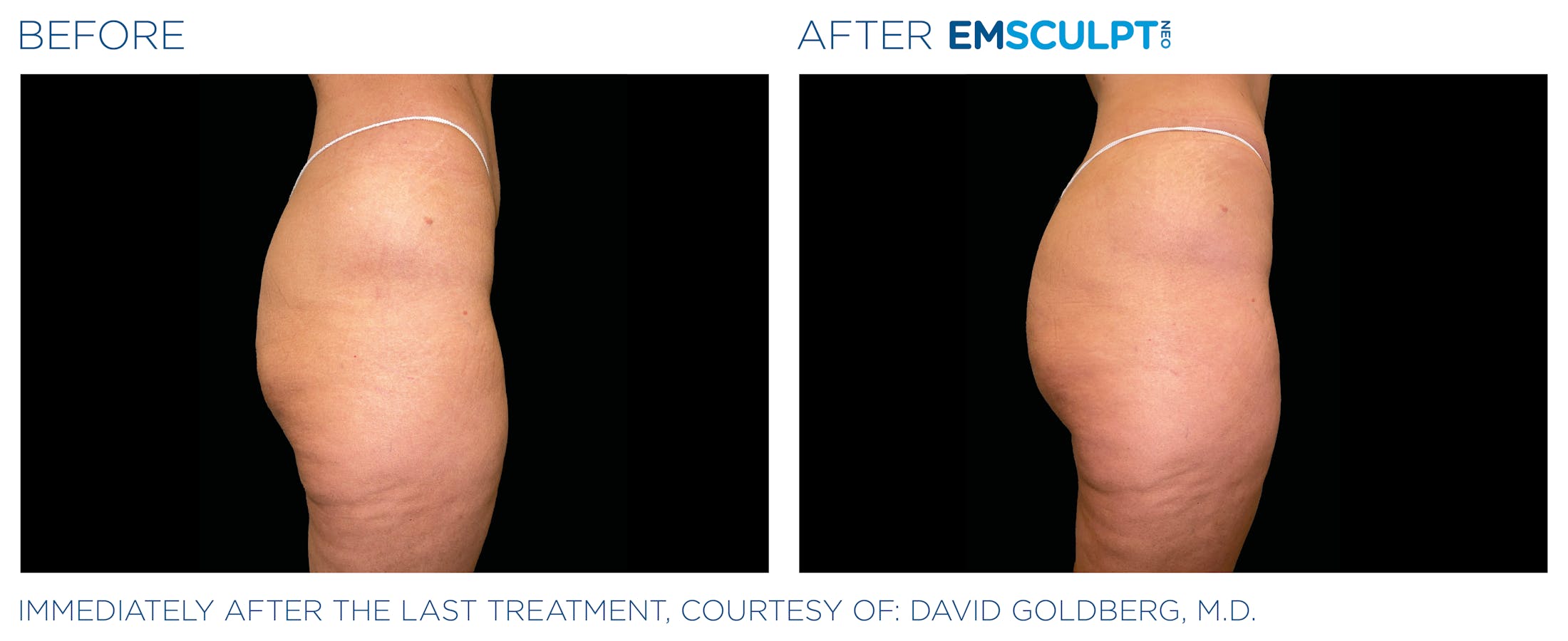Emsculpt before & after