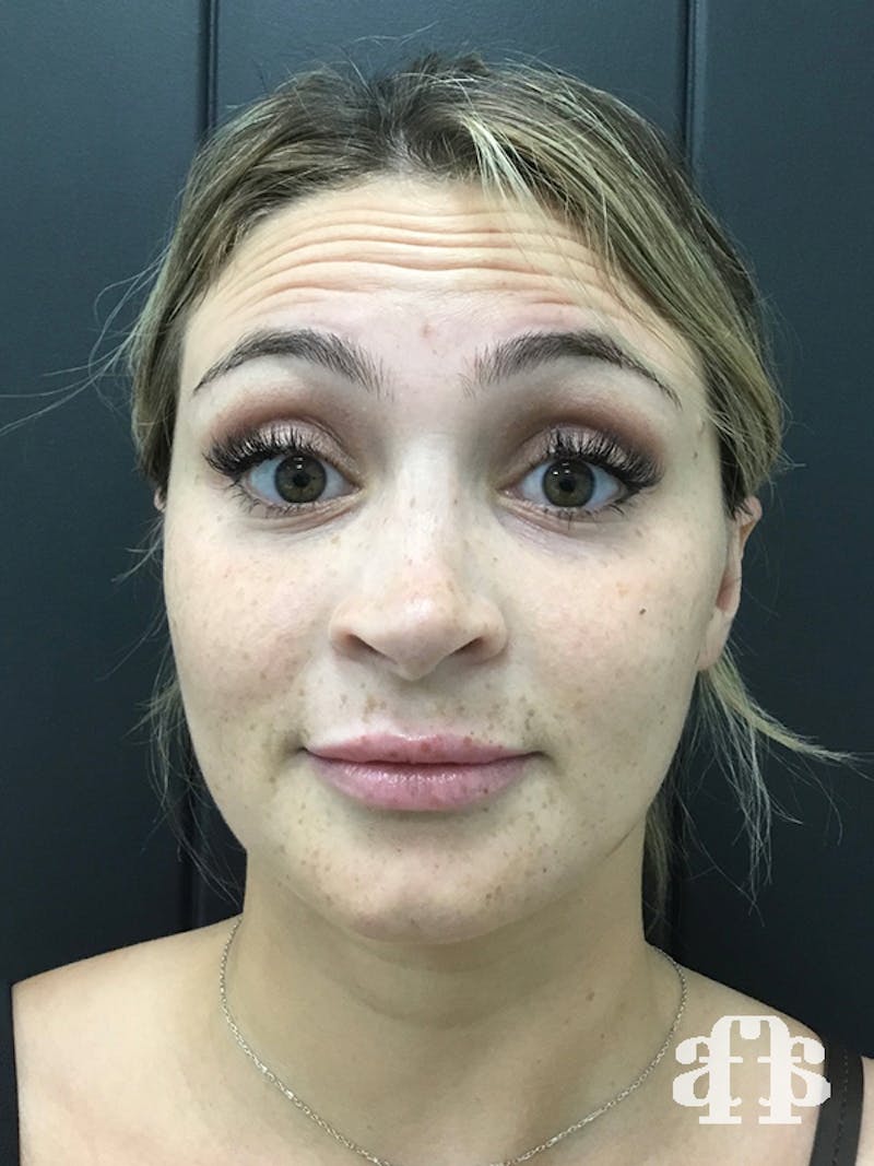 Botox Before & After Gallery - Patient 95443639 - Image 1