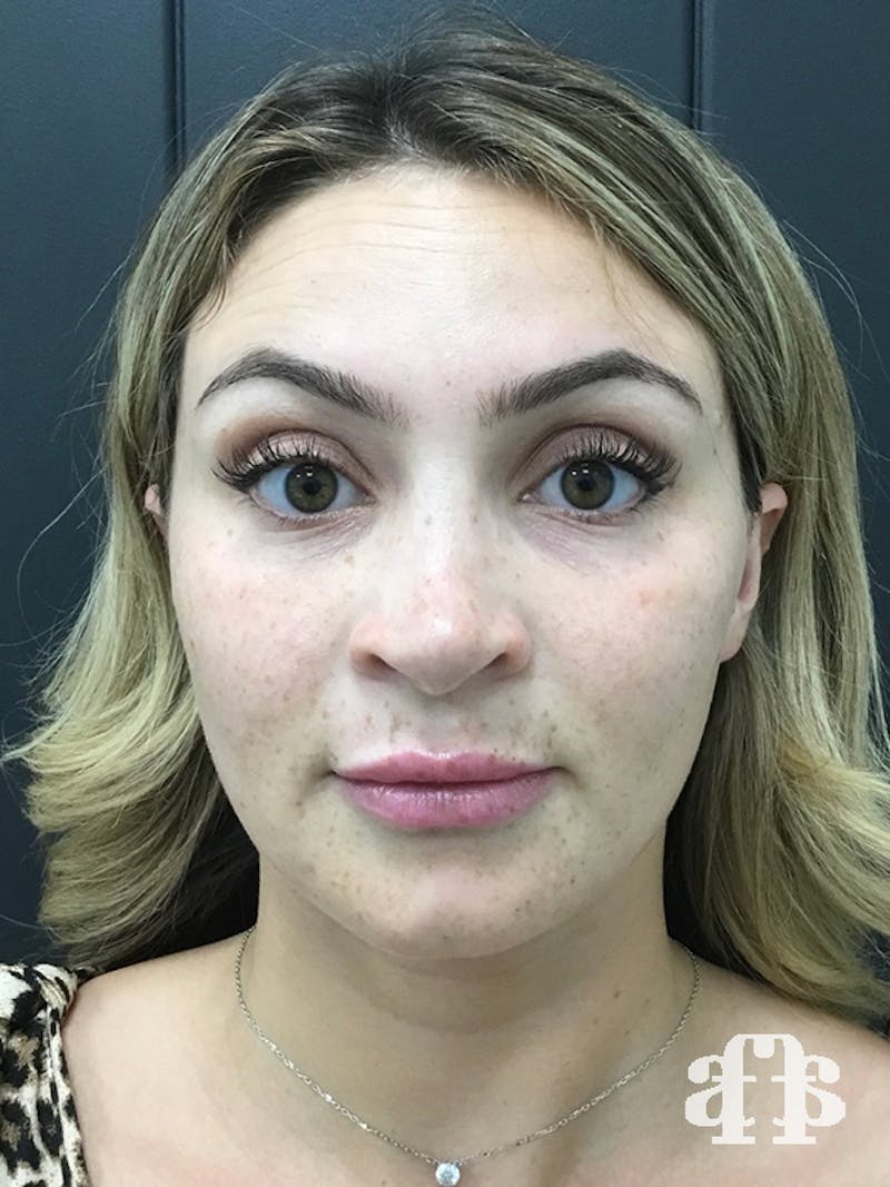 Botox Before & After Gallery - Patient 95443639 - Image 2