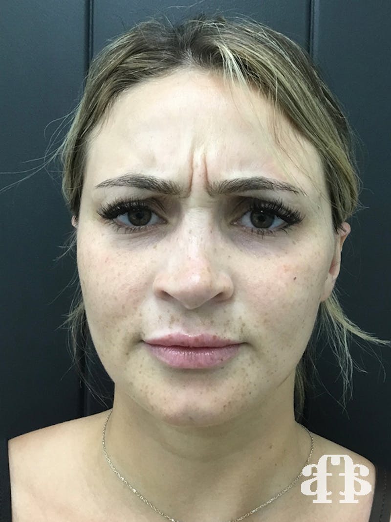 Botox Before & After Gallery - Patient 95443639 - Image 3