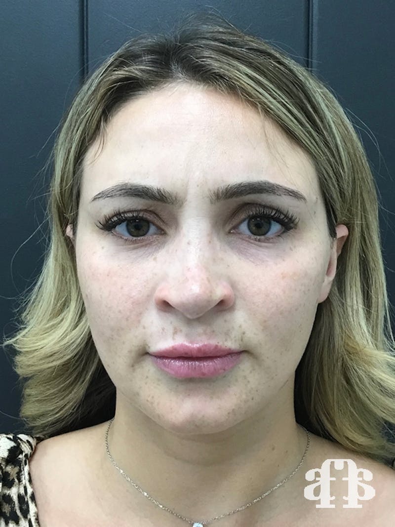 Botox Before & After Gallery - Patient 95443639 - Image 4
