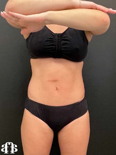 CoolSculpting Before & After Gallery - Patient 121515755 - Image 2