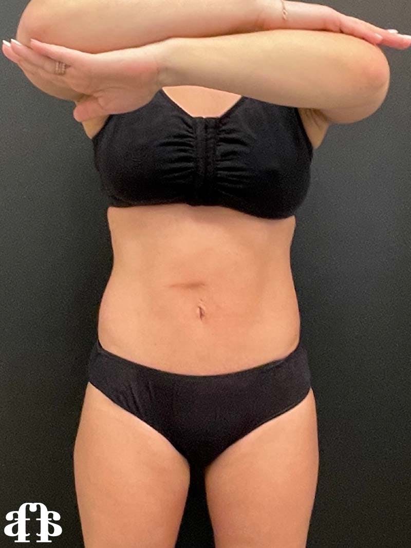 CoolSculpting Before & After Gallery - Patient 121515755 - Image 2
