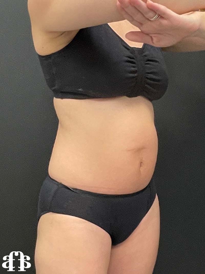 CoolSculpting Before & After Gallery - Patient 121515755 - Image 3