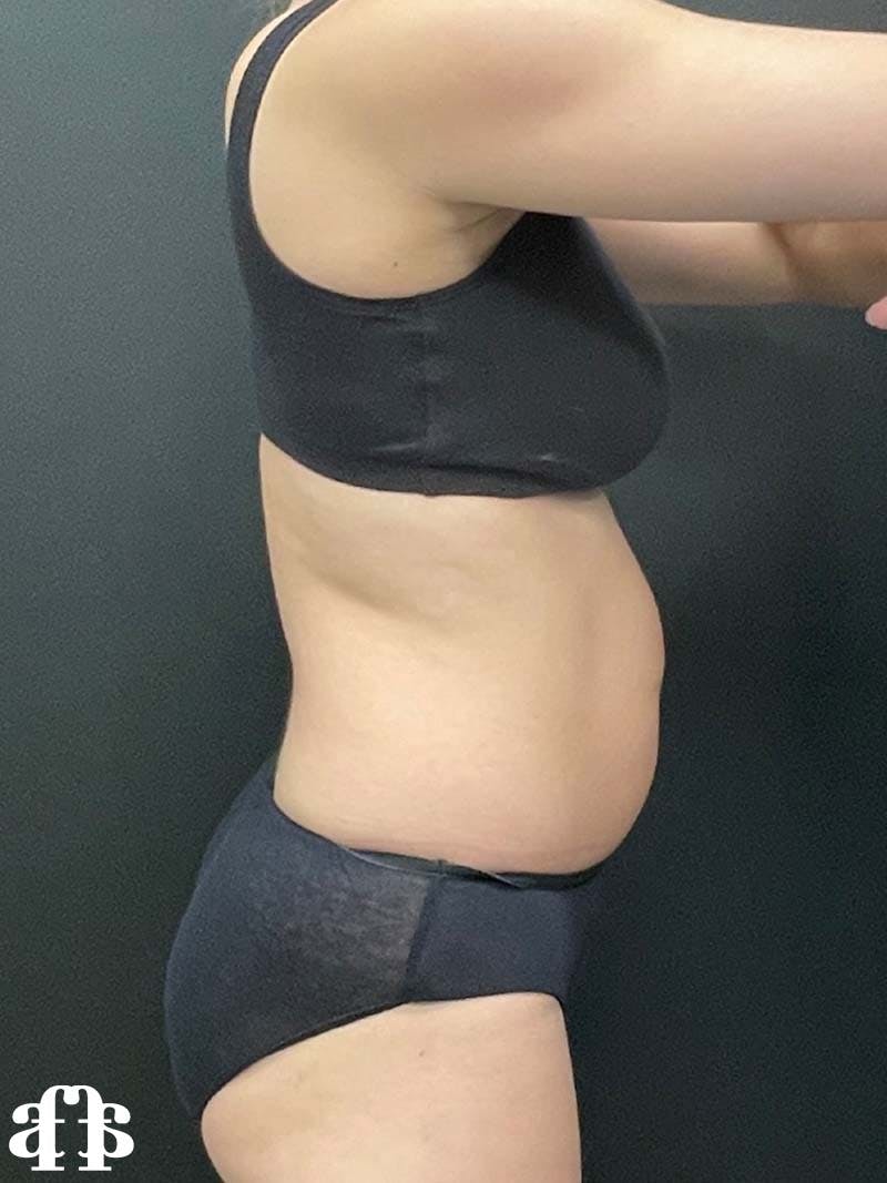 CoolSculpting Before & After Gallery - Patient 121515755 - Image 5