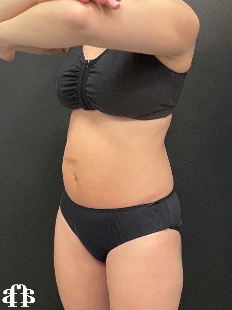 CoolSculpting Before & After Gallery - Patient 121515755 - Image 7