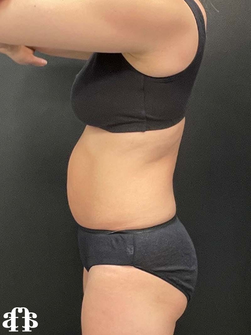 CoolSculpting Before & After Gallery - Patient 121515755 - Image 9