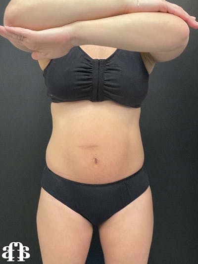 CoolSculpting Gallery - Patient 121515755 - Image 1