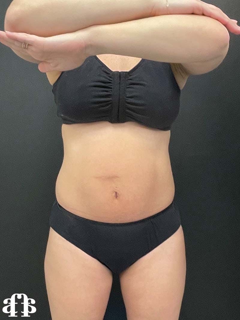 CoolSculpting Before & After Gallery - Patient 121515755 - Image 1