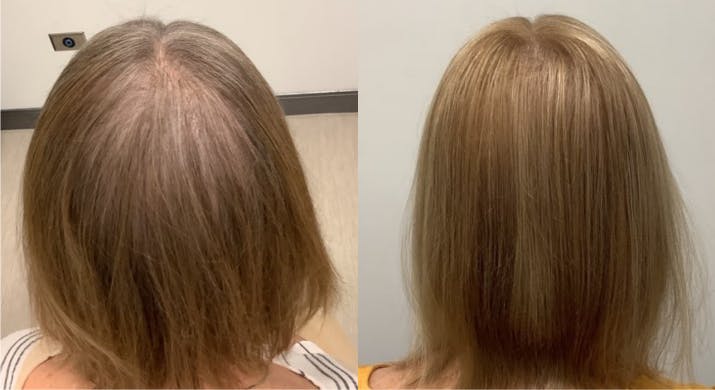 Before & After Alma TED Hair Restoration