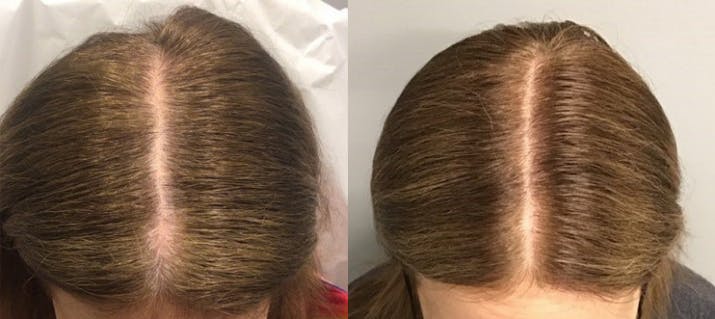 Before & After Alma TED Hair Restoration