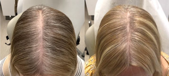 Before & After Alma TED Hair Restoration