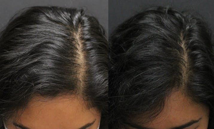 Before & After Alma TED Hair Restoration