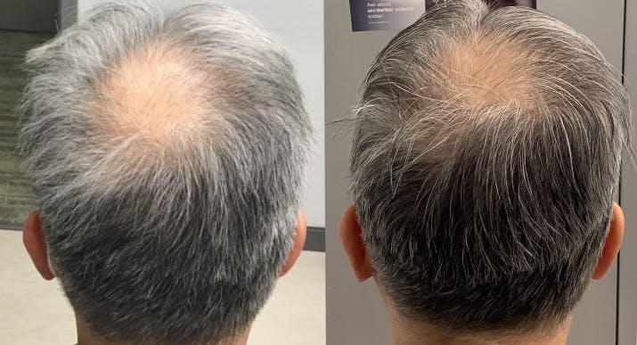 Before & After Alma TED Hair Restoration
