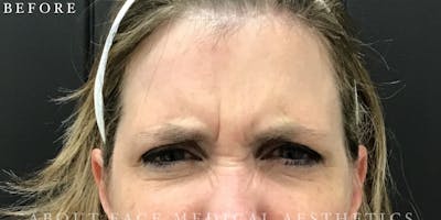 Botox Before & After Gallery - Patient 146209795 - Image 1