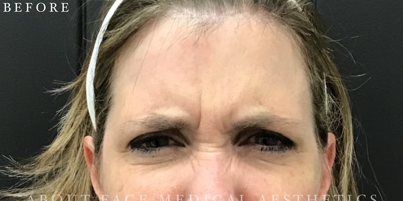 Botox Before & After Gallery - Patient 146209795 - Image 1