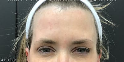 Botox Before & After Gallery - Patient 146209795 - Image 2
