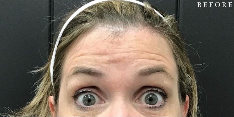 Botox Before & After Gallery - Patient 146209795 - Image 3