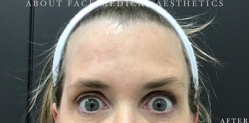 Botox Before & After Gallery - Patient 146209795 - Image 4
