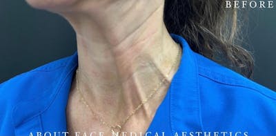 Botox Before & After Gallery - Patient 146209799 - Image 1