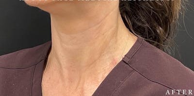 Botox Before & After Gallery - Patient 146209799 - Image 2