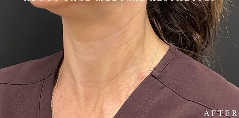 Botox Before & After Gallery - Patient 146209799 - Image 2