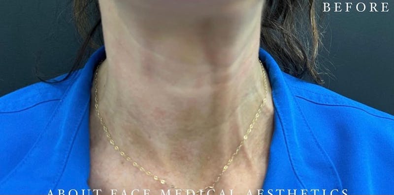 Botox Before & After Gallery - Patient 146209799 - Image 3