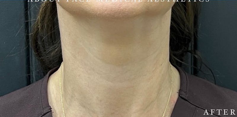 Botox Before & After Gallery - Patient 146209799 - Image 4