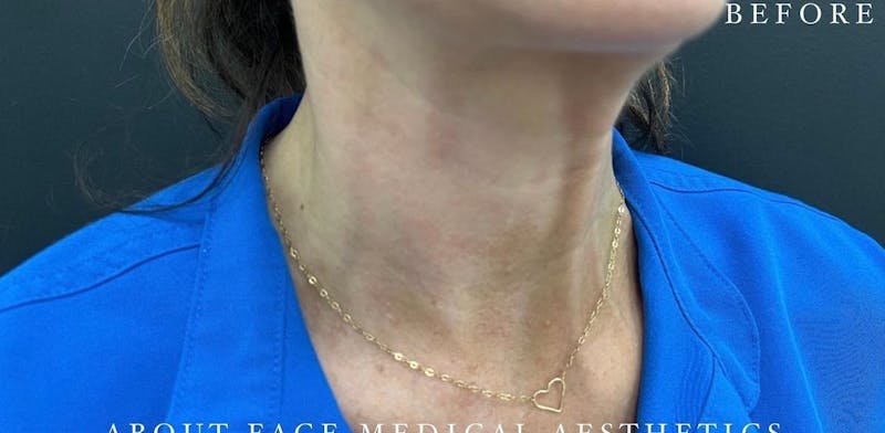 Botox Before & After Gallery - Patient 146209799 - Image 5