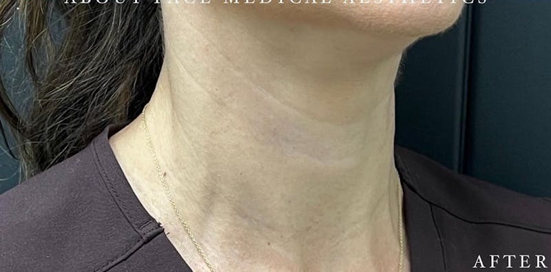 Botox Before & After Gallery - Patient 146209799 - Image 6