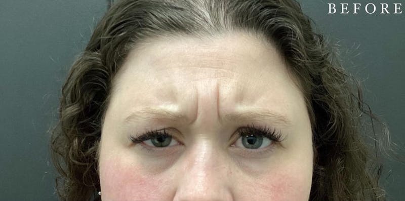 Botox Before & After Gallery - Patient 146210060 - Image 1